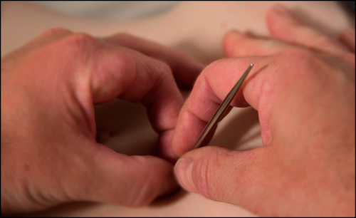 Acupuncture Photo
